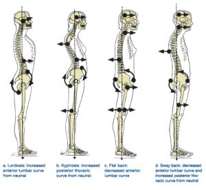 bad-posture-spine