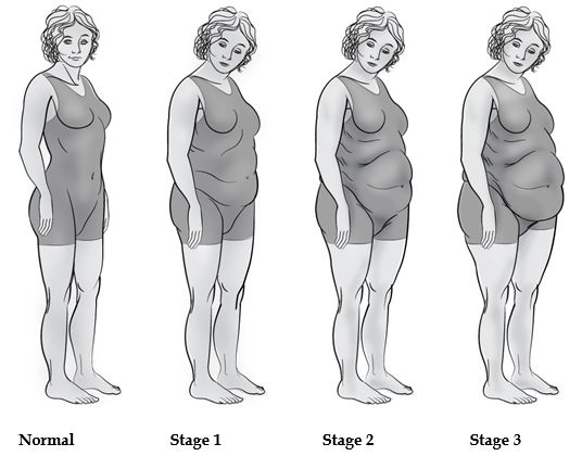 adrenal-fatigue-bt-stages