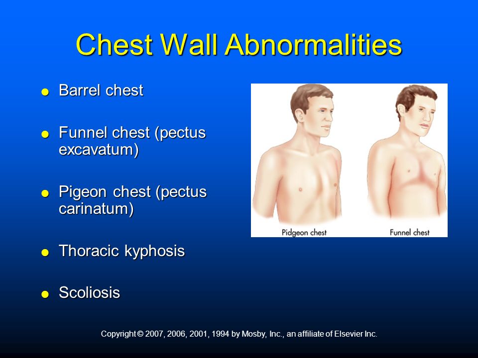 Barrel chest. Funnel chest (pectus excavatum) Pigeon chest (pectus carinatum) Thoracic kyphosis. Scoliosis. Copyright © 2007, 2006, 2001, 1994 by Mosby, Inc., an affiliate of Elsevier Inc.